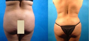 Liposuction and Tummy Tuck before 134078