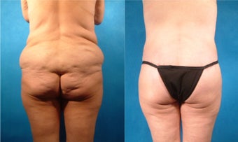 Lower Body Lift with Fat Transfer and Liposuction before 134085