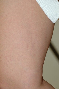 Leg vein removal after 106536