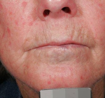 Vascular malformations after 135917