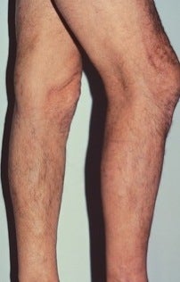 Phlebectomy Leg Vein Removal after 370430