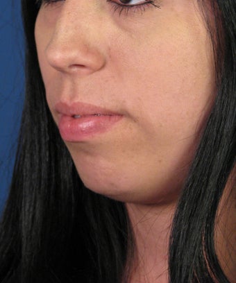 Chin Implant before 534045