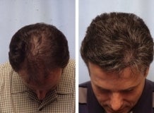Hair replacement with Fleming/Mayer flap after 143618