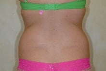 Liposuction before 177562