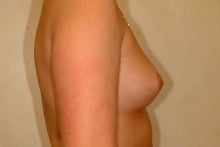 Breast augmentation before 157752