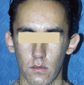 Bilateral Otoplasty (EAR-SET BACK) before 147640