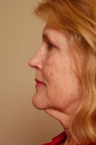 Refresher Facelift w/Neck Pliction, Browlift, TCA Peel Lower Lids, Fat Injections to Cheeks & Lips before 252878