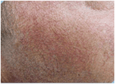 Photofacial/IPL before 267551