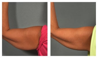 CoolSculpting before 541955