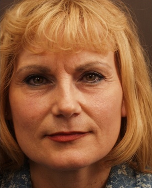 Blepharoplasty before 164763