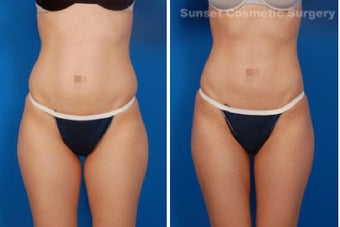 Liposuction before 485265