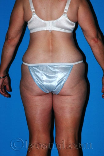 Lower Body Lift and Tumescent Liposuction before 233085