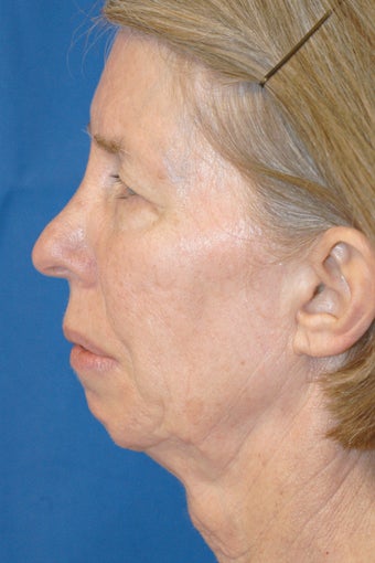 Face Lift 322007