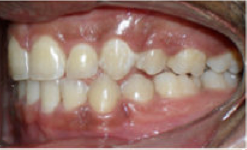 Braces and Extraction 349088