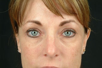 Restylane after 531619