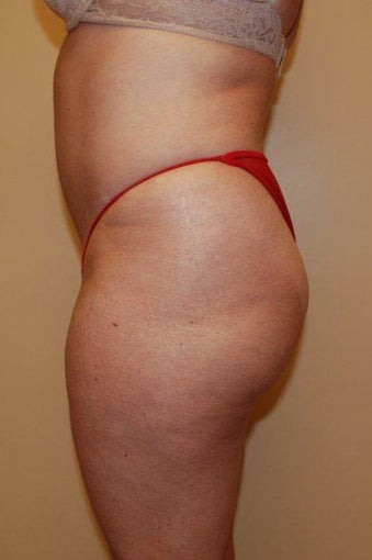 Buttock Augmentation 516167