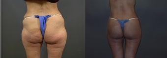 Body Lift before 581681