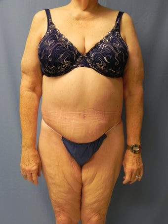 Circumferential Body Lift after 364633
