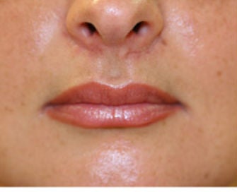 Modified lip lift after 299924