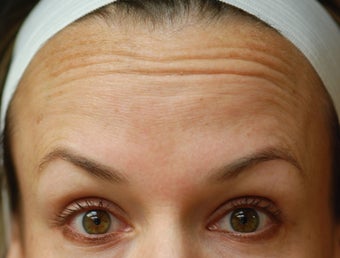 Dysport in the horizontal forehead lines. before 624778
