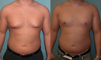Gynecomastia Surgery before 340651