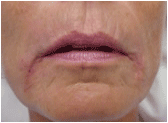 Restylane after 267543