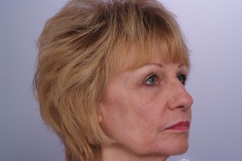 Laser Resurfacing after 253083