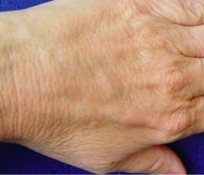 Radiesse hand rejuvenation after 374252