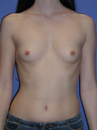 Breast Augmentation Surgery before 102267