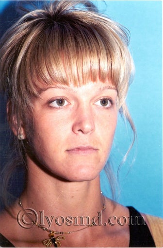 Cheek and Lip Enhancement - Facial Plastic Surgery before 225062