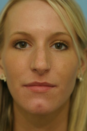 rhinoplasty before 274193