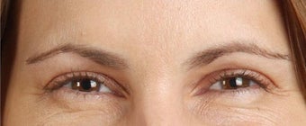 Botox Results after 271679
