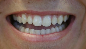 porcelain bridge with veneers replacing teeth 466255