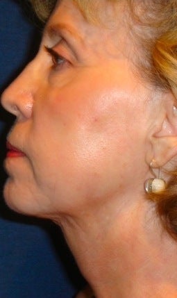 Neck liposculpture after 374887