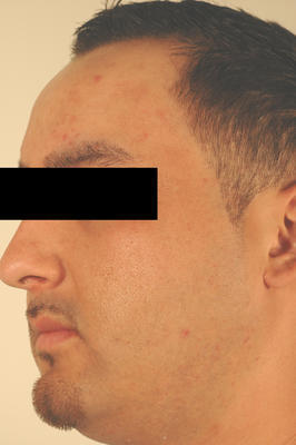 Laser Acne Treatment after 82957