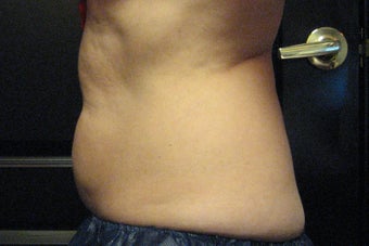 Zeltiq CoolSculpting before 300930