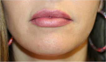 Lip Filler - Juverderm after 114510