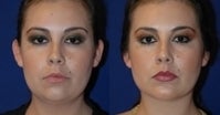 Liposuction of neck with chin implant before 388374