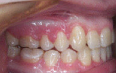 Damon Braces 379871