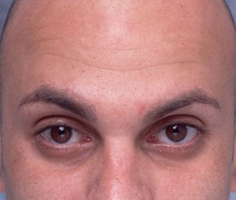 Cosmetic Microdroplet BOTOX® Treatment after 118541