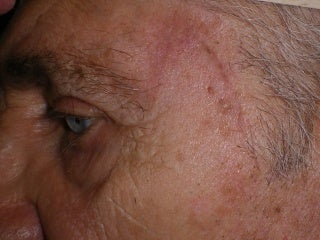 Basal Cell Carcinomas Excisions after 272099