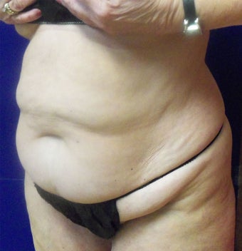 VASER Shape to Abdomen before 433046