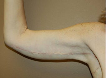 arm tuck after 258899