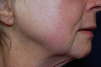 Fractional CO2-Total FX Wrinkle Treatment after 572421