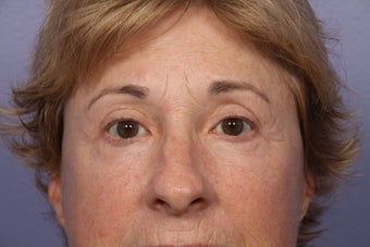 Eyelid Surgery after 306434