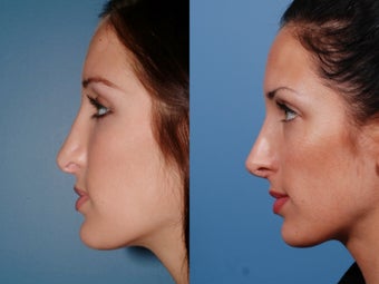 Revision rhinoplasty after 435947