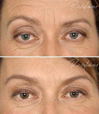 Before and after Restylane Perlane before 6287
