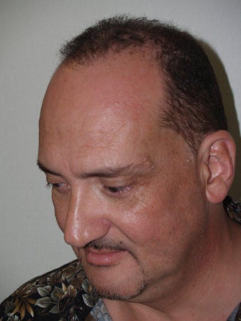 Hair Transplant - 3400 grafts after 235612