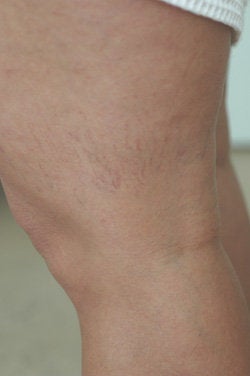 Leg vein removal before 106536