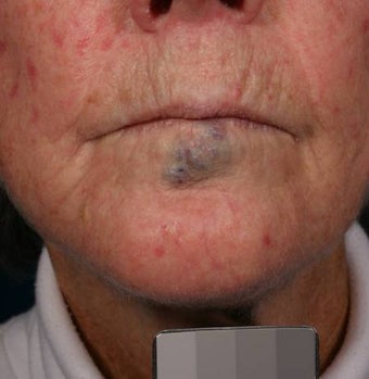 Vascular malformations before 135917